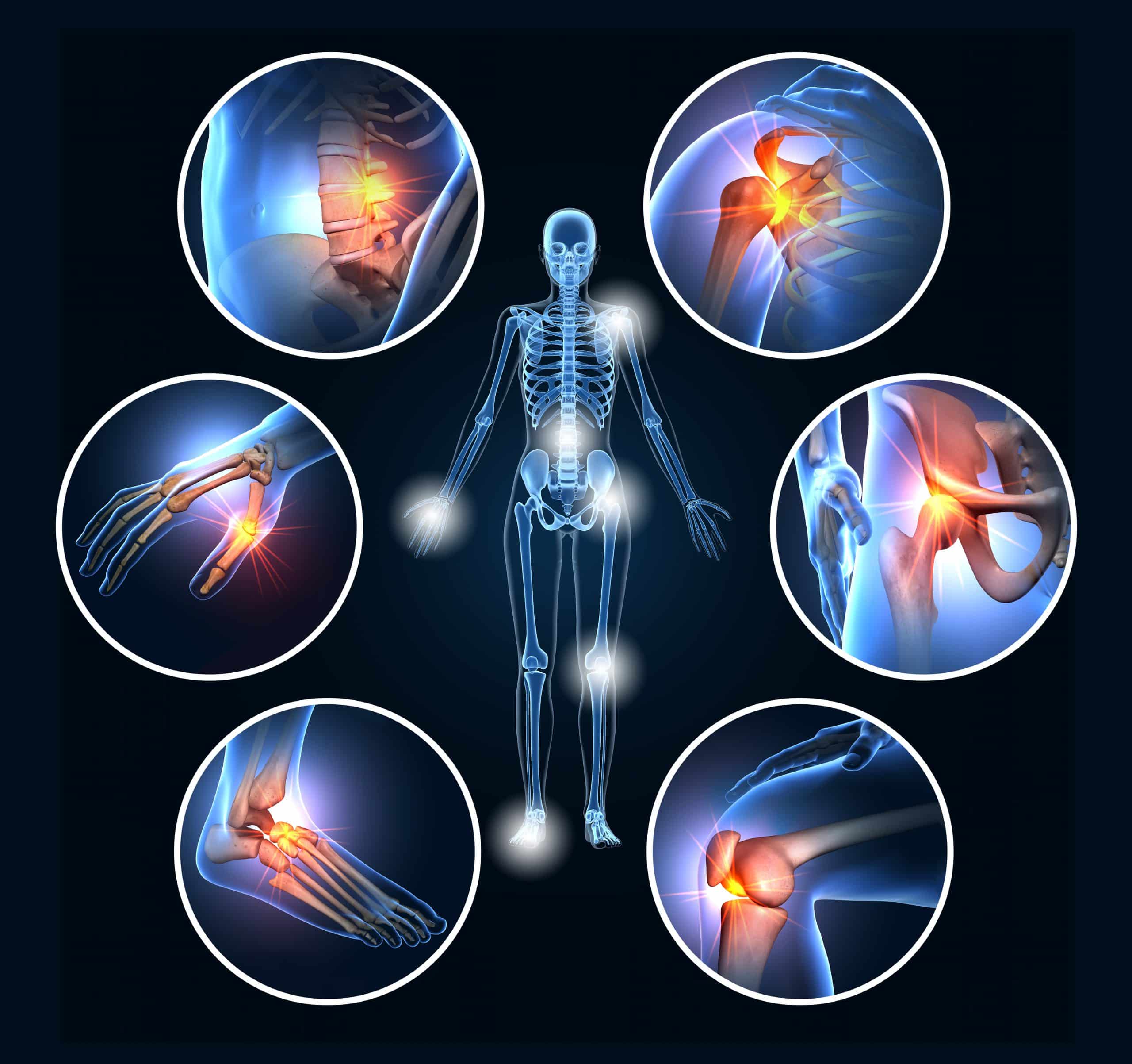 Arthritis