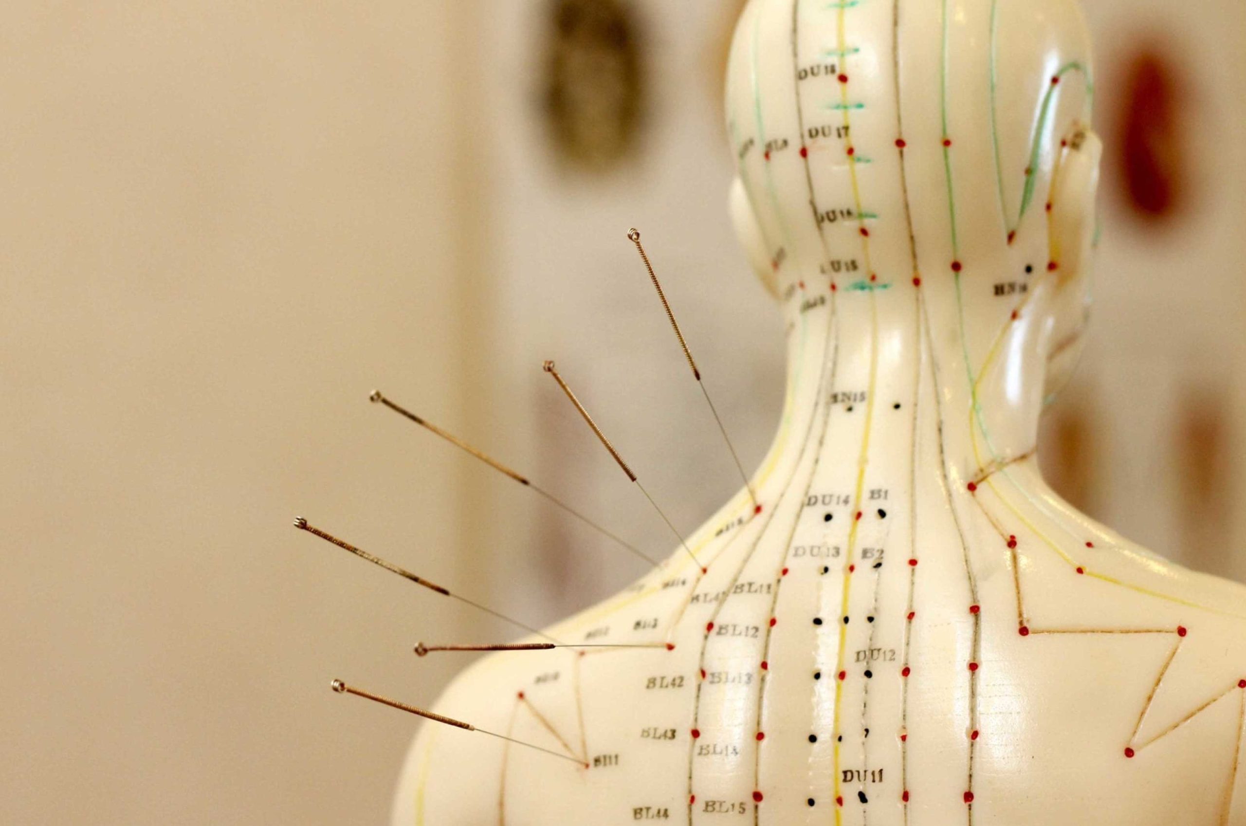 Acupuncture Treatment Surrey BC